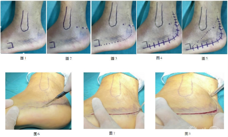 跟骨l形切口的应用技巧 