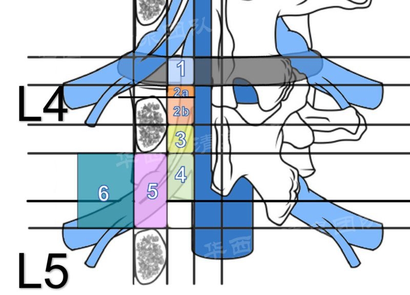 椎管测量示意图图片